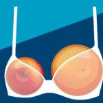 Asimetría focal en la mama: causas y significado de esta condición